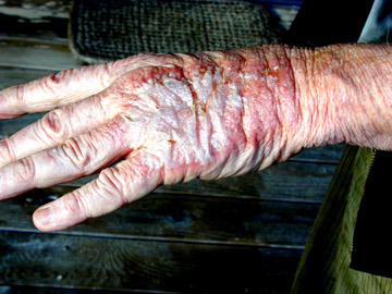 Chemotherapy Drugs - Bio Hazard